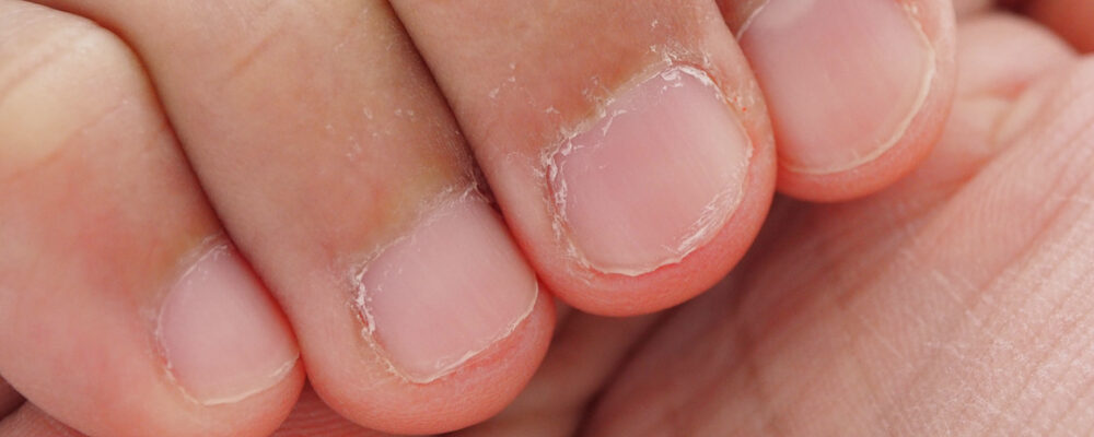cutícula de uñas seca