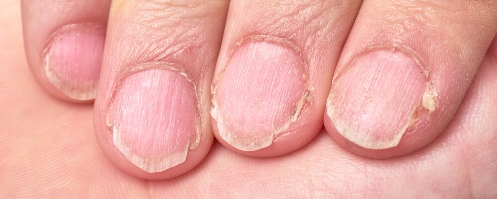 uñas secas