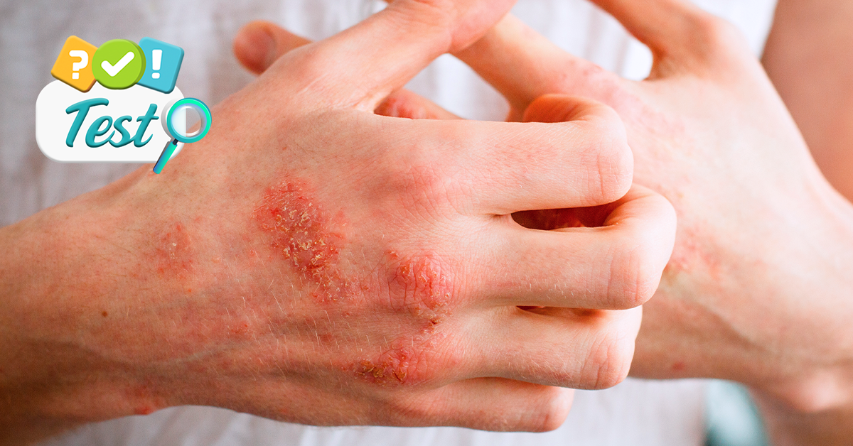 ¿Sufres de dermatitis de contacto?