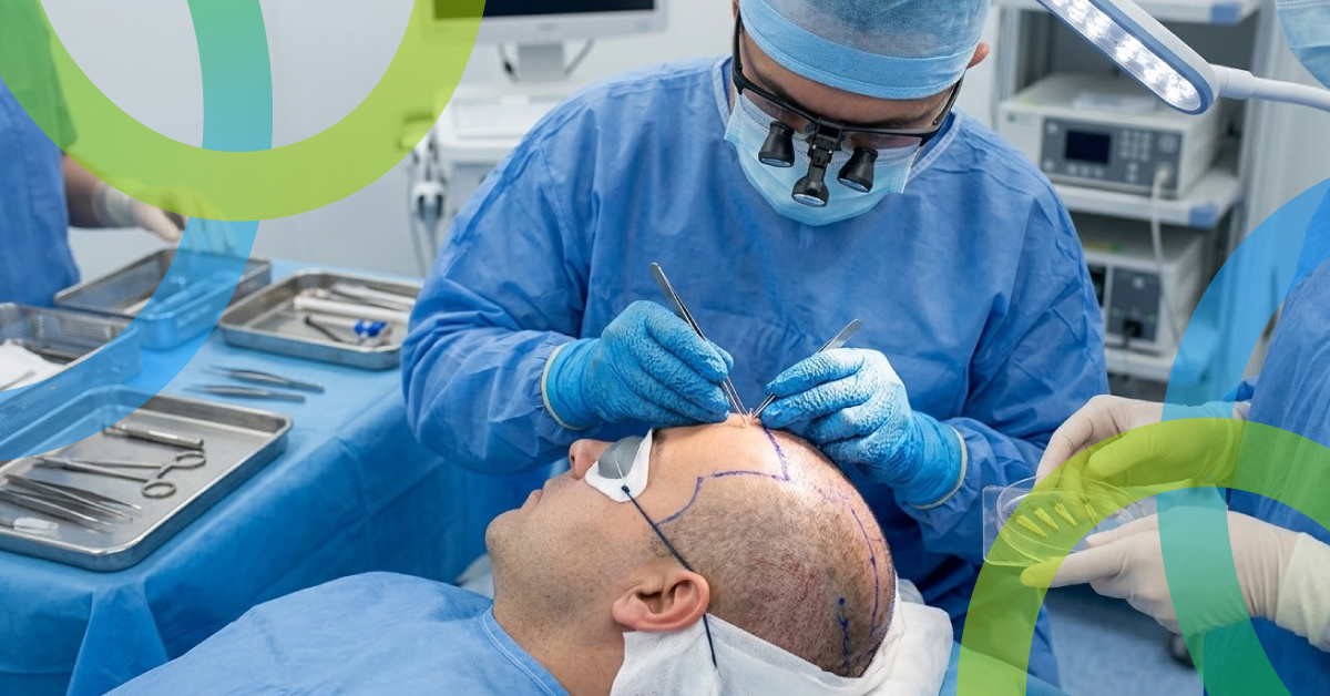 El auge de los trasplantes de pelo en hombres